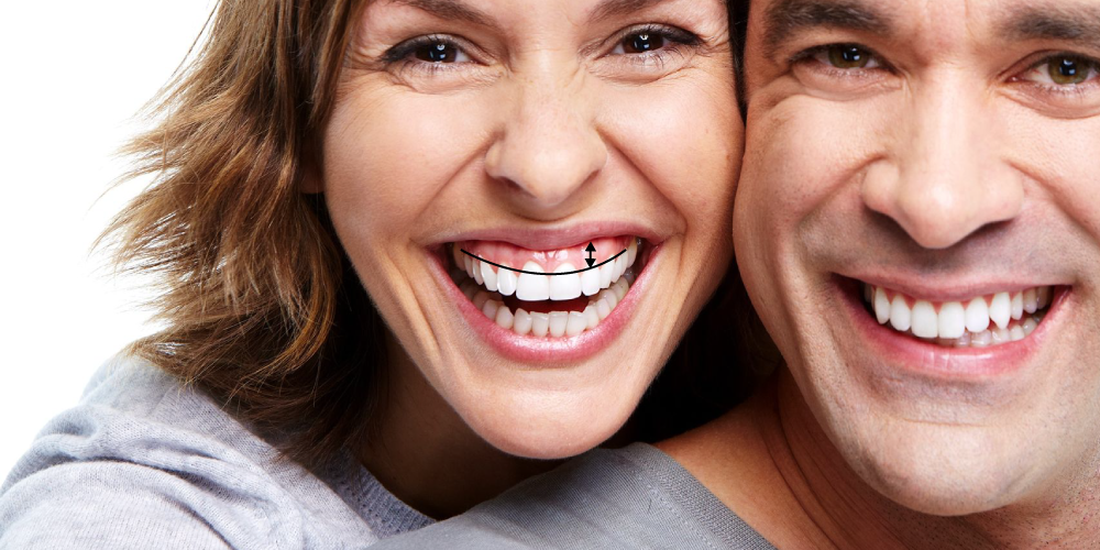 gingivectomía