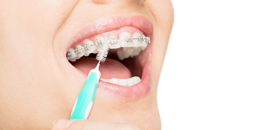 cuidar brackets