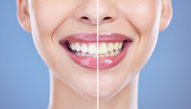 cómo prolongar el blanqueamiento dental