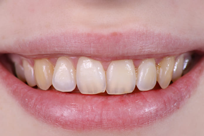 fluorosis-dental